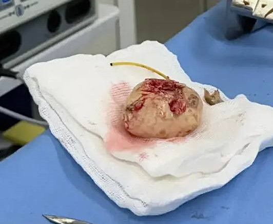 Кузбассовец лишился почки на операционном столе