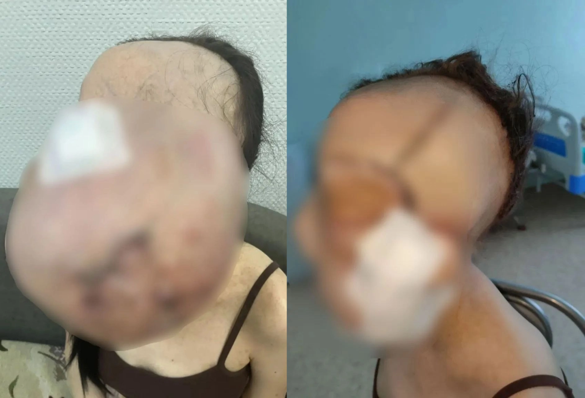 В Кузбассе хирурги-онкологи удалили с лица девушки опухоль весом 5 кг