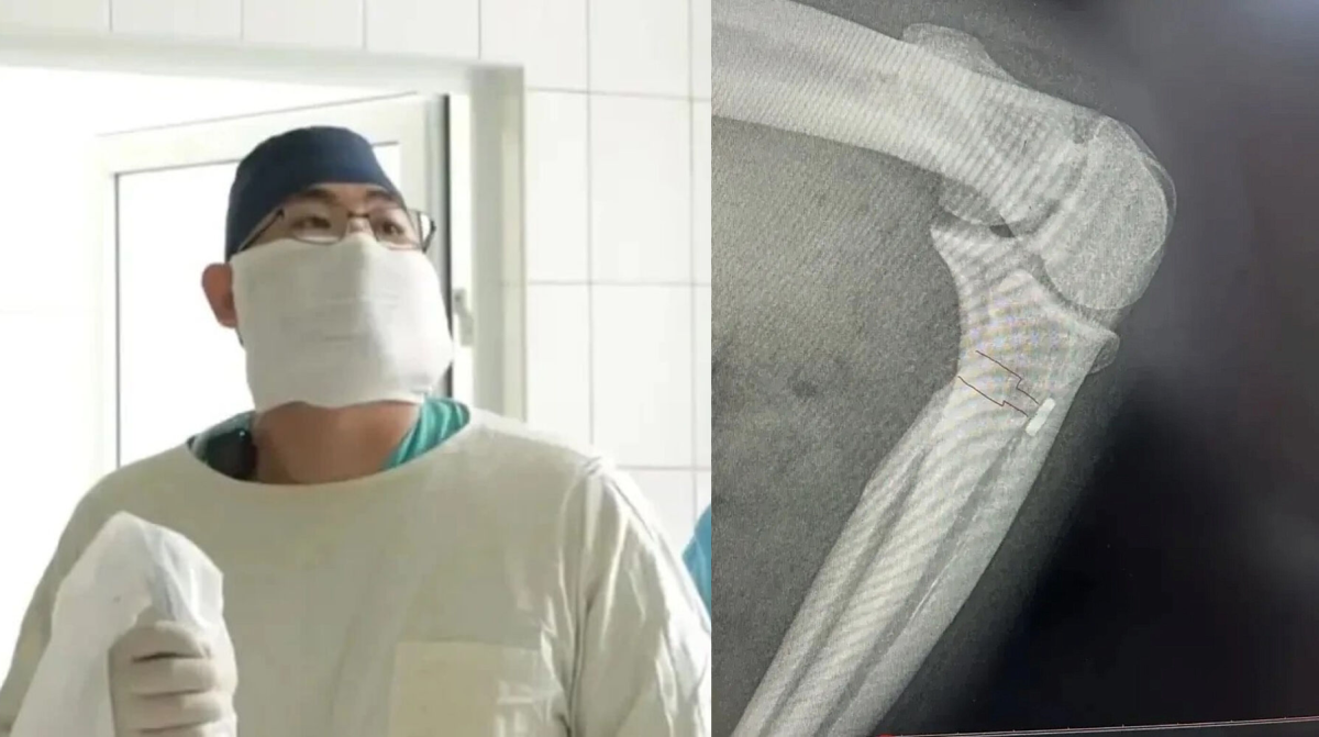 В Прокопьевске врачи пересадили пациенту часть мышцы с ноги в руку