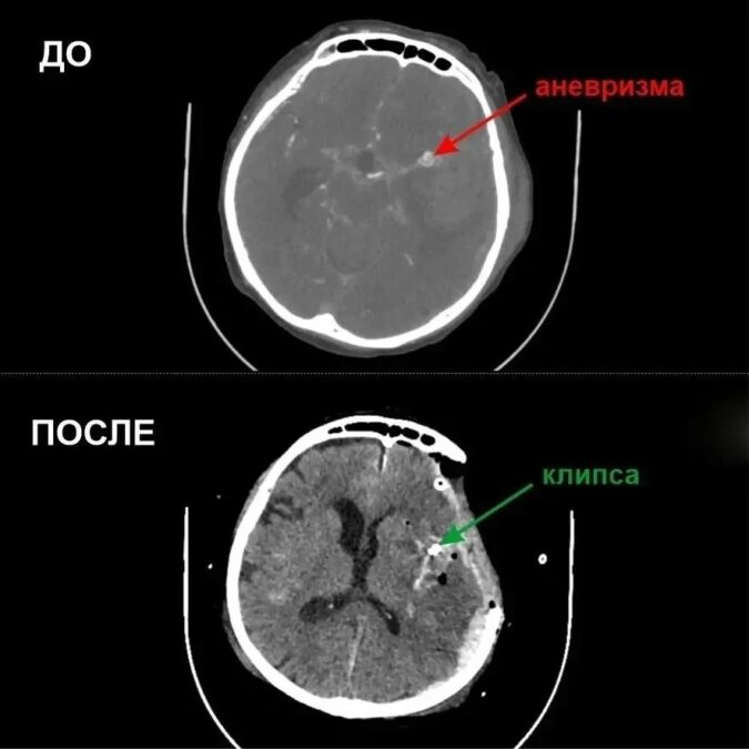 С того света — к жизни. В Кузбассе нейрохирурги спасли 67‑летнюю пациентку С того света — к жизни. В Кузбассе нейрохирурги спасли 67‑летнюю пациентку