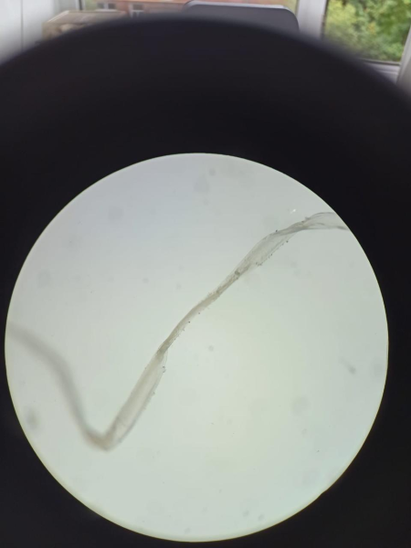 В Кузбассе врачи извлекли из глаза женщины червя