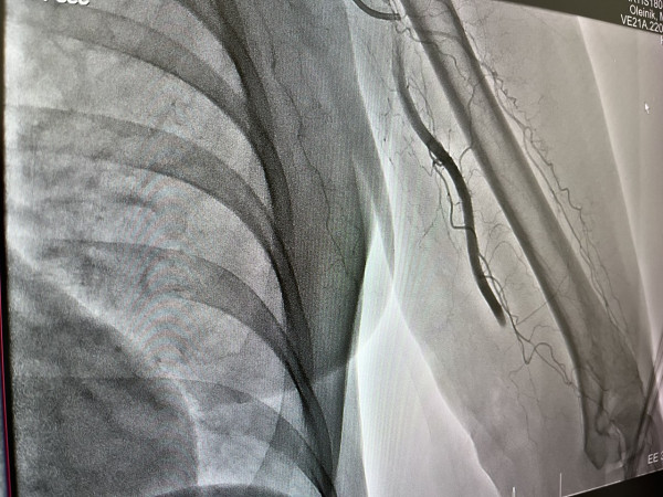 Причиной сильной боли в руке у жительницы Кузбасса стал семисантиметровый тромб в артерии