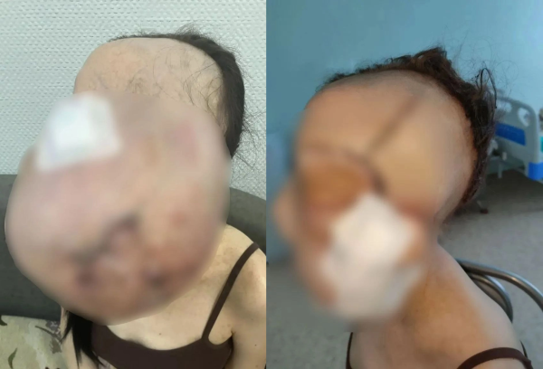 В Кузбассе хирурги-онкологи удалили с лица девушки опухоль весом 5 кг