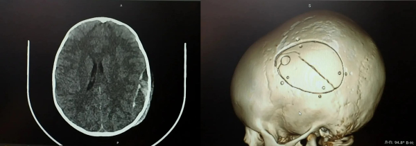 В Кузбассе 5-летнему ребёнку пришлось проводить трепанацию черепа после падения с эскалатора